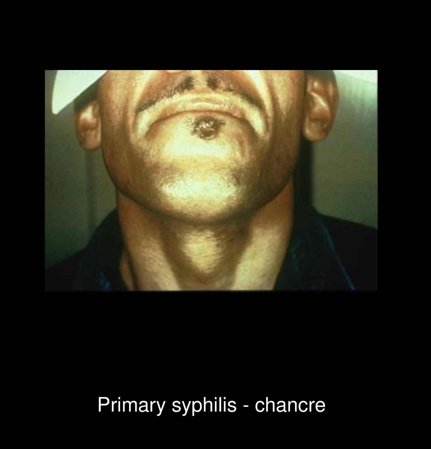 Secondary syphilis papular rash on face showing disseminated copper-colored papules with characteristic distribution and morphology